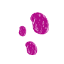 seborrheic ketatosis